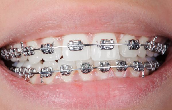 Aparat ortodontyczny